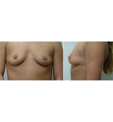 Breast Implants Over Muscle Before